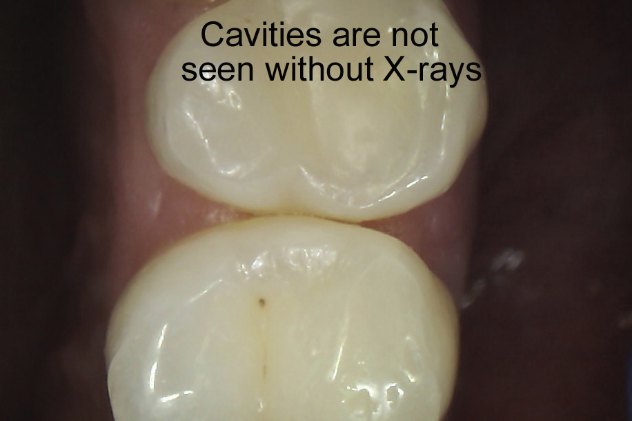 davis-implant-dentist-cavities-in-real-life-and-in-x-rays