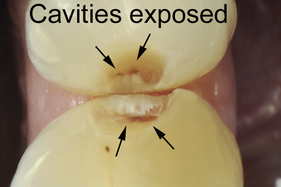 Davis Implant Dentist Cavities In Real Life And In X Rays