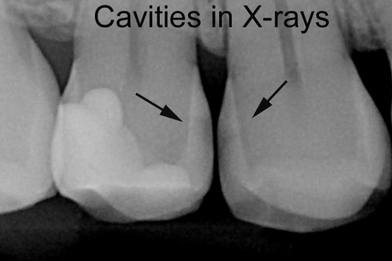 davis-implant-dentist-cavities-in-real-life-and-in-x-rays