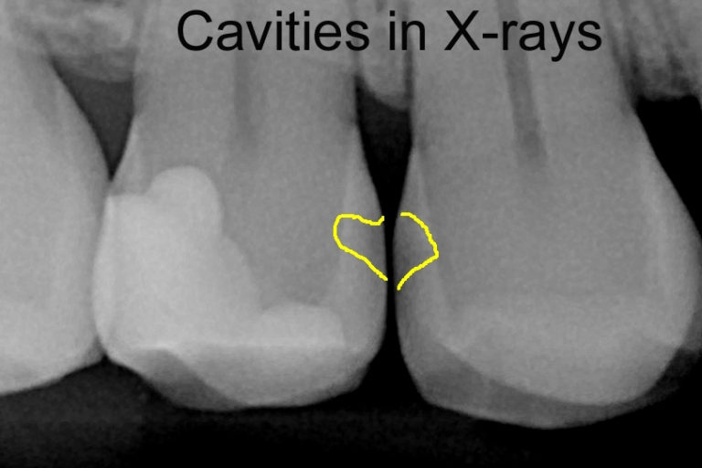 Davis CA Family Dentist | Cavities in real life and in X-rays – James W ...